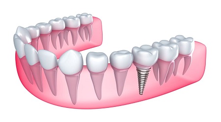 Dental implants