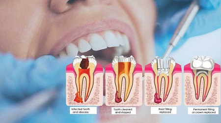 Root canals